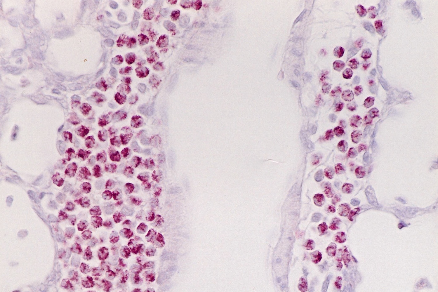 Microscope image of stained tissue showing clusters of dark pink cells within pale purple histology structures.